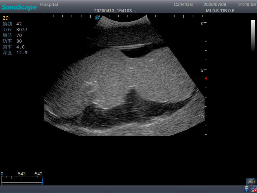 Amniocentesis Ultrasound Trainer